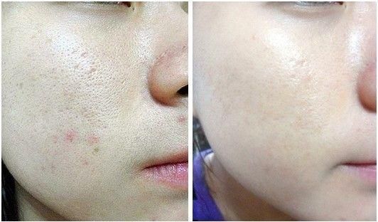 黑頭毛孔粗大油膩用什么產品好_黑頭毛孔粗大油皮怎么辦_毛孔粗大黑頭多皮膚油應該怎么辦